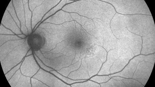 Macular Serpiginous Chorioretinopathy
75 year old vision with central placoid lesions.  She tested negative for TB and Syphilis.  The final visual acuity in both eyes was 1/200.
