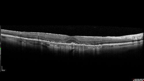 Macular Serpiginous Chorioretinopathy
75 year old vision with central placoid lesions.  She tested negative for TB and Syphilis.  The final visual acuity in both eyes was 1/200.
