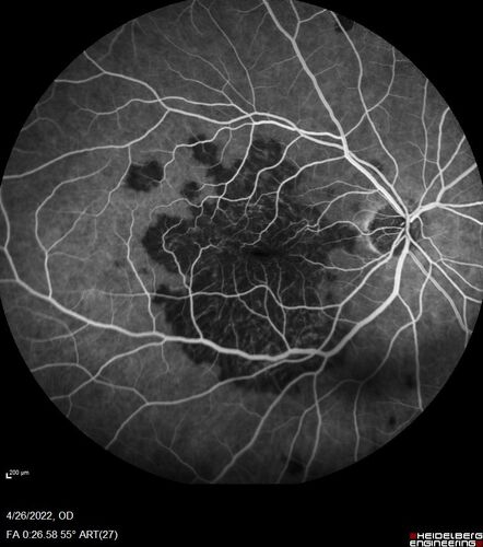 Macular Serpiginous Chorioretinopathy
75 year old vision with central placoid lesions.  She tested negative for TB and Syphilis.  The final visual acuity in both eyes was 1/200.
