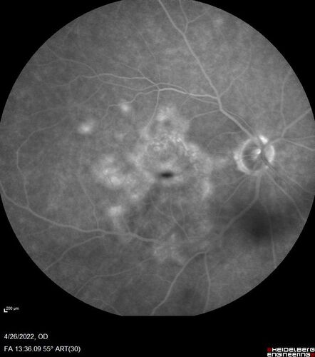Macular Serpiginous Chorioretinopathy
75 year old vision with central placoid lesions.  She tested negative for TB and Syphilis.  The final visual acuity in both eyes was 1/200.

