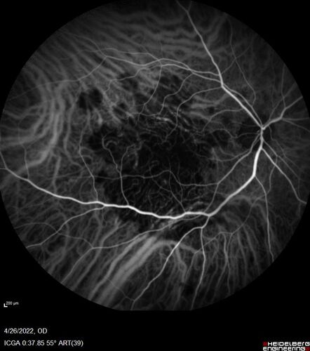 Macular Serpiginous Chorioretinopathy
75 year old vision with central placoid lesions.  She tested negative for TB and Syphilis.  The final visual acuity in both eyes was 1/200.
