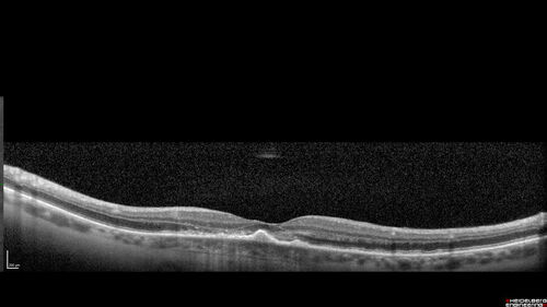 Macular Serpiginous Chorioretinopathy
75 year old vision with central placoid lesions.  She tested negative for TB and Syphilis.  The final visual acuity in both eyes was 1/200.
