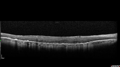 Macular Serpiginous Chorioretinopathy
75 year old vision with central placoid lesions.  She tested negative for TB and Syphilis.  The final visual acuity in both eyes was 1/200.
