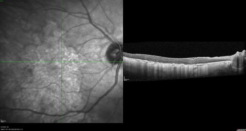 Macular Serpiginous Chorioretinopathy
75 year old vision with central placoid lesions.  She tested negative for TB and Syphilis.  The final visual acuity in both eyes was 1/200.
