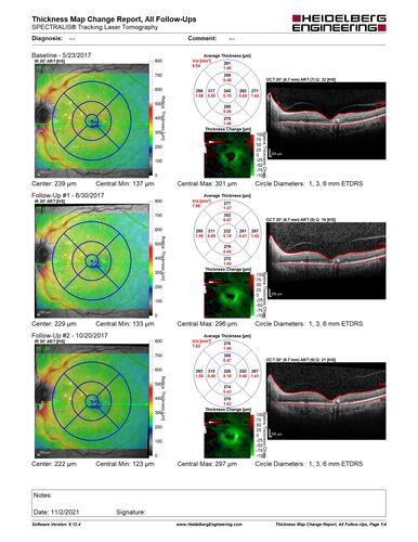 Stage V (neovascular) Macular Telangiectasia - Fluorescein
67 year old female with vision in only the left eye.  She has mild CNVM which is treated with Avastin and does well over several  years.

