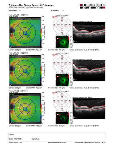 Stage V (neovascular) Macular Telangiectasia - Fluorescein
67 year old female with vision in only the left eye.  She has mild CNVM which is treated with Avastin and does well over several  years.
