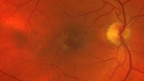MacTel with foveal atrophy in both eyes
62 year old female with 20/50 OD, 20/40 OS.
