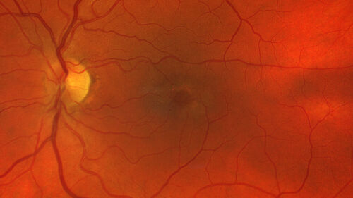 MacTel with foveal atrophy in both eyes
62 year old female with 20/50 OD, 20/40 OS.
