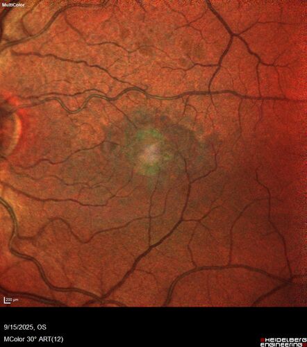 MacTel with foveal atrophy in both eyes
62 year old female with 20/50 OD, 20/40 OS.
