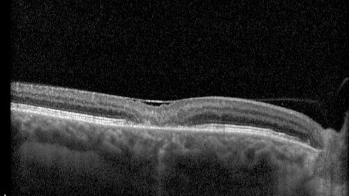 MacTel with foveal atrophy in both eyes
62 year old female with 20/50 OD, 20/40 OS.
