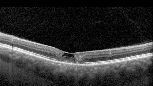 MacTel with foveal atrophy in both eyes
62 year old female with 20/50 OD, 20/40 OS.
