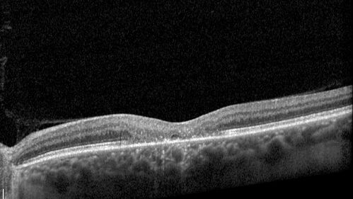 MacTel with foveal atrophy in both eyes
62 year old female with 20/50 OD, 20/40 OS.
