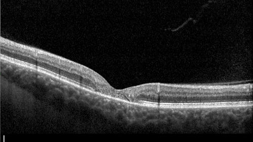 MacTel with foveal atrophy in both eyes
62 year old female with 20/50 OD, 20/40 OS.

