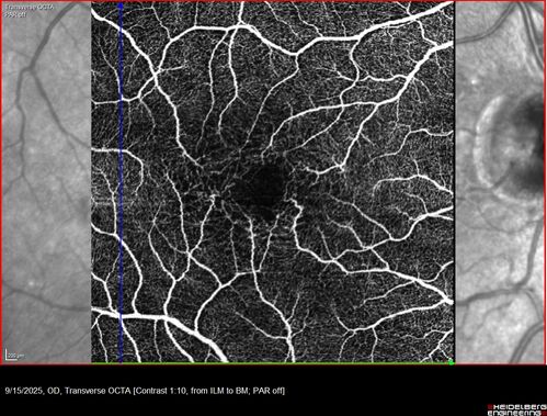 MacTel with foveal atrophy in both eyes
62 year old female with 20/50 OD, 20/40 OS.
