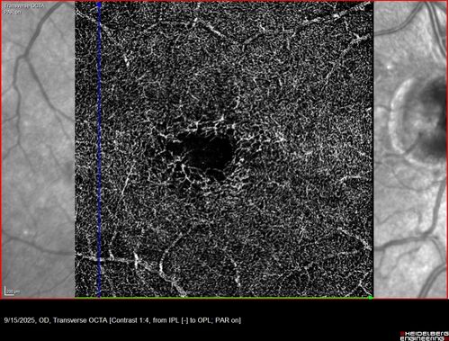 MacTel with foveal atrophy in both eyes
62 year old female with 20/50 OD, 20/40 OS.
