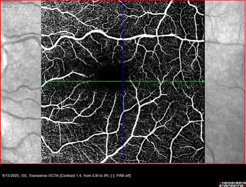 MacTel with foveal atrophy in both eyes
62 year old female with 20/50 OD, 20/40 OS.
