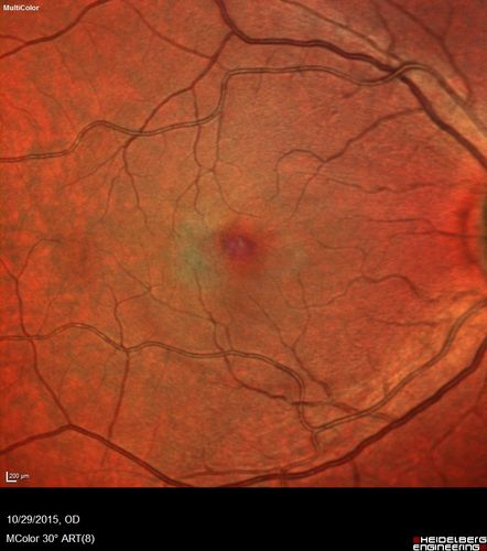 Macular Telangiectasis (MacTel)
False color
