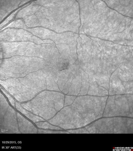 Macular Telangiectasis (MacTel)
