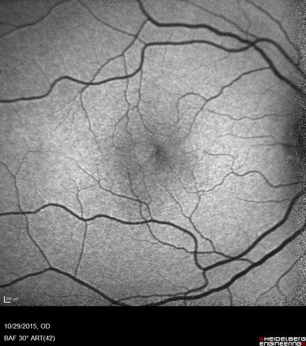 Macular Telangiectasis (MacTel)
FAF shows decrease macular pigment

