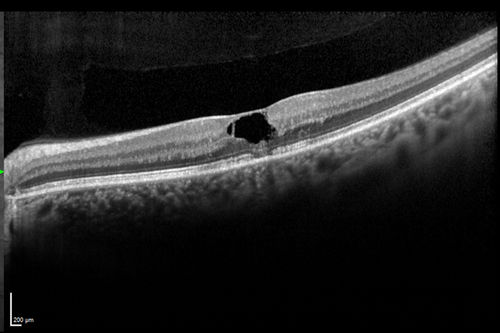 Macular Telangiectasis (MacTel)
