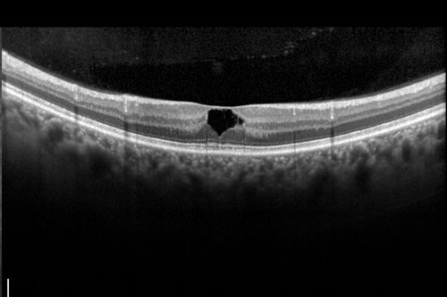 Macular Telangiectasis (MacTel)
