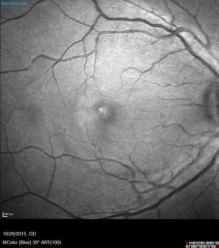 Macular Telangiectasis (MacTel) - Blue Reflectance
Gray ring is less visible after the retina is exposed to bright light.  This could be from bleaching of intraretinal chromophores if they are the source of the gray ring.  
