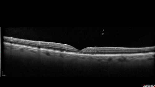 Macular telangiectasia - images from 10 years later - crystals 
75 year old man with MacTel and a lot of crystals  VA 20/63 OD, 20/50 OS.
