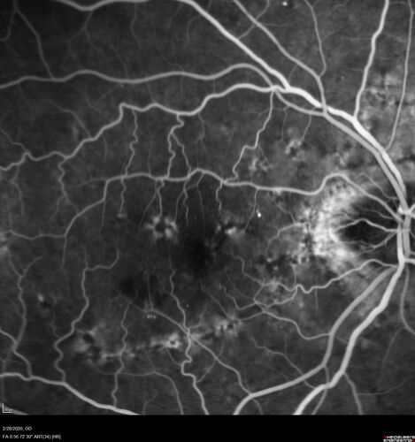 Macular Telangiectasia (MacTel) and Pattern Dystrophy
71 year old man with diabetes for 5 years and blurred vision in the left eye. VA 20/25 OD, 20/50 OS.  OCT OS shows MacTel

