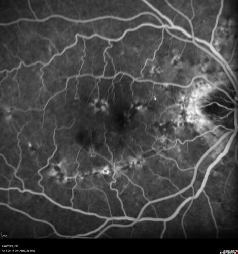 Macular Telangiectasia (MacTel) and Pattern Dystrophy
71 year old man with diabetes for 5 years and blurred vision in the left eye. VA 20/25 OD, 20/50 OS.  OCT OS shows MacTel
