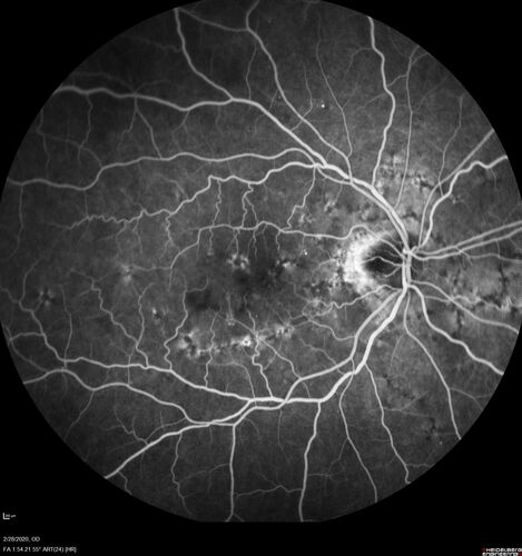 Macular Telangiectasia (MacTel) and Pattern Dystrophy
71 year old man with diabetes for 5 years and blurred vision in the left eye. VA 20/25 OD, 20/50 OS.  OCT OS shows MacTel
