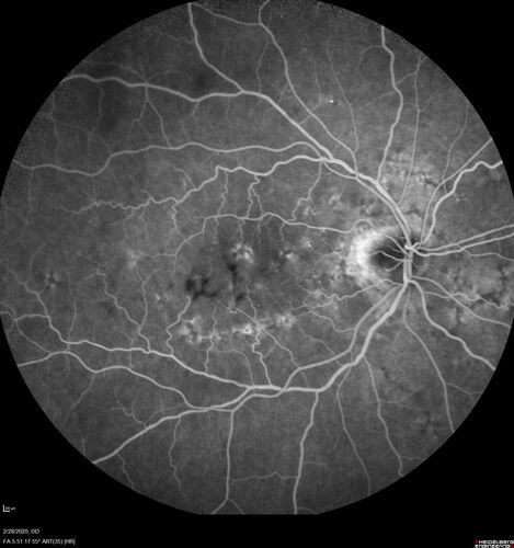 Macular Telangiectasia (MacTel) and Pattern Dystrophy
71 year old man with diabetes for 5 years and blurred vision in the left eye. VA 20/25 OD, 20/50 OS.  OCT OS shows MacTel
