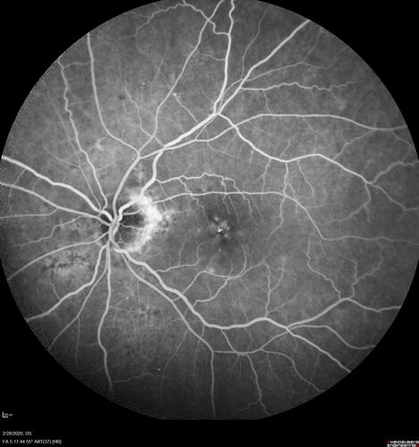 Macular Telangiectasia (MacTel) and Pattern Dystrophy
71 year old man with diabetes for 5 years and blurred vision in the left eye. VA 20/25 OD, 20/50 OS.  OCT OS shows MacTel
