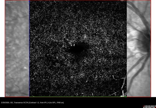 Macular Telangiectasia (MacTel) and Pattern Dystrophy
71 year old man with diabetes for 5 years and blurred vision in the left eye. VA 20/25 OD, 20/50 OS.  OCT OS shows MacTel
