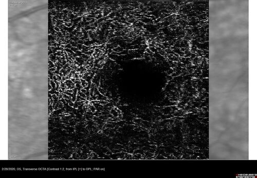 Macular Telangiectasia (MacTel) and Pattern Dystrophy
71 year old man with diabetes for 5 years and blurred vision in the left eye. VA 20/25 OD, 20/50 OS.  OCT OS shows MacTel
