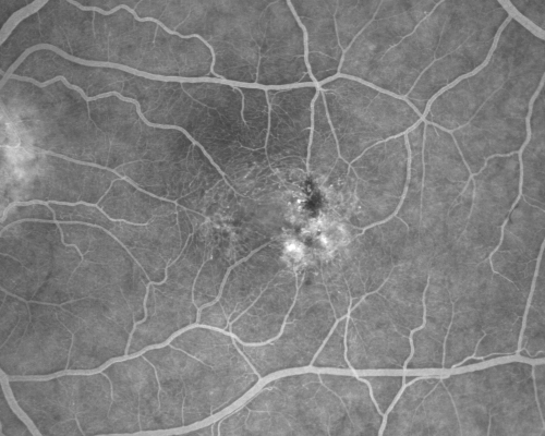 Juxtafoveal Telangiectasis - (MacTel) - Stage 4 both Eyes
57-year-old woman with a history of decreased vision.  The patient reports that her vision has been gradually decreasing in the left more so than the right eye. 20/50 OD and 20/60
