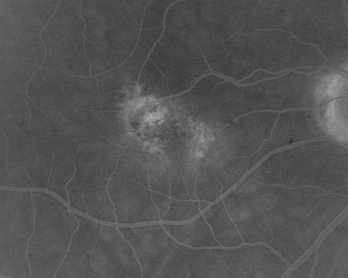 Juxtafoveal Telangiectasis - (MacTel) - Stage 4 both Eyes
57-year-old woman with a history of decreased vision.  The patient reports that her vision has been gradually decreasing in the left more so than the right eye. 20/50 OD and 20/60
