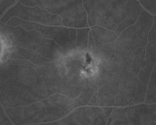 Juxtafoveal Telangiectasis - (MacTel) - Stage 4 both Eyes
57-year-old woman with a history of decreased vision.  The patient reports that her vision has been gradually decreasing in the left more so than the right eye. 20/50 OD and 20/60
