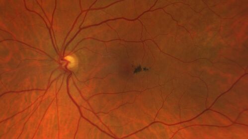 Macular Telangiectasis (MacTel) Both Eye - Stage IV - Pigment Spots
63 year old female with Type II DM x 4 years.  Vision is 20/40 both eyes.
