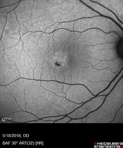 Macular Telangiectasis (MacTel) Both Eye - Stage IV - Pigment Spots
63 year old female with Type II DM x 4 years.  Vision is 20/40 both eyes.
