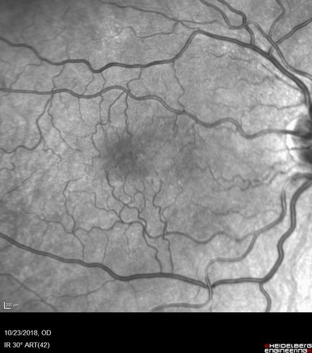 Macular Telangiectasis - Mild - Retinal Crystals
58 year old man with long term mild vision loss.  Considering Cataract surgery.  VA 20/50 OD and 20/63 OS - Moderate cataract are present
