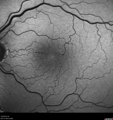 Macular Telangiectasis - Mild - Retinal Crystals
58 year old man with long term mild vision loss.  Considering Cataract surgery.  VA 20/50 OD and 20/63 OS - Moderate cataract are present
