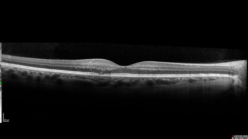 Macular Telangiectasis - Mild - Retinal Crystals
58 year old man with long term mild vision loss.  Considering Cataract surgery.  VA 20/50 OD and 20/63 OS - Moderate cataract are present
