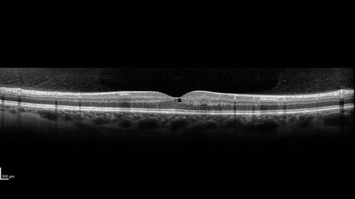 Macular Telangiectasis - Mild - Retinal Crystals
58 year old man with long term mild vision loss.  Considering Cataract surgery.  VA 20/50 OD and 20/63 OS - Moderate cataract are present
