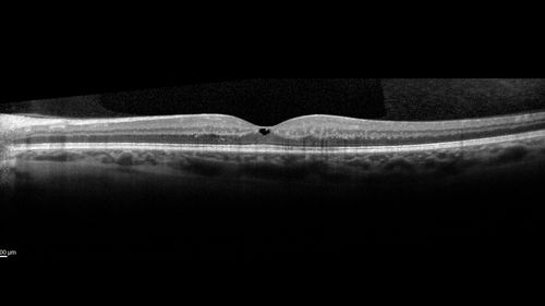Macular Telangiectasis - Mild - Retinal Crystals
58 year old man with long term mild vision loss.  Considering Cataract surgery.  VA 20/50 OD and 20/63 OS - Moderate cataract are present
