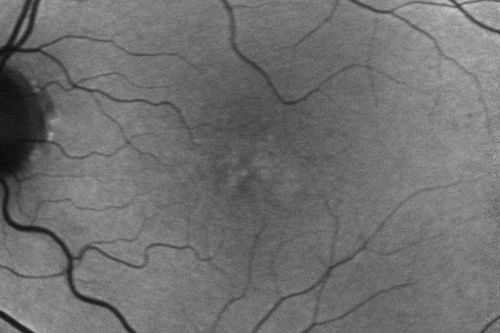 Macular Telangiectasis (Group 2a Juxtafoveal Telangiectasis) Decreased Fundus Autofluorescence
63-year-old woman has juxtafoveal retinal telangiectasis in both eyes.  She notices her vision a little worse with more distortion and change over the last six months.  

VISUAL ACUITY:  OD 20/40,  OS 20/40.
