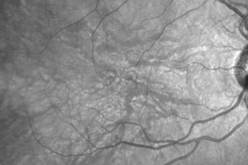 Macular Telangiectasis (Group 2a Juxtafoveal Telangiectasis) IR
63-year-old woman has juxtafoveal retinal telangiectasis in both eyes.  She notices her vision a little worse with more distortion and change over the last six months.  

VISUAL ACUITY:  OD 20/40,  OS 20/40.
