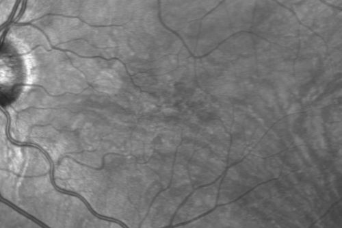 Macular Telangiectasis (Group 2a Juxtafoveal Telangiectasis) IR
63-year-old woman has juxtafoveal retinal telangiectasis in both eyes.  She notices her vision a little worse with more distortion and change over the last six months.  

VISUAL ACUITY:  OD 20/40,  OS 20/40.

