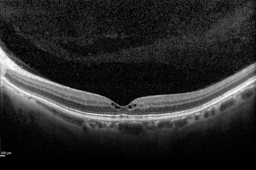 Macular Telangiectasis (Group 2a Juxtafoveal Telangiectasis) Decreased Fundus Autofluorescence
63-year-old woman has juxtafoveal retinal telangiectasis in both eyes.  She notices her vision a little worse with more distortion and change over the last six months.  

VISUAL ACUITY:  OD 20/40,  OS 20/40.
