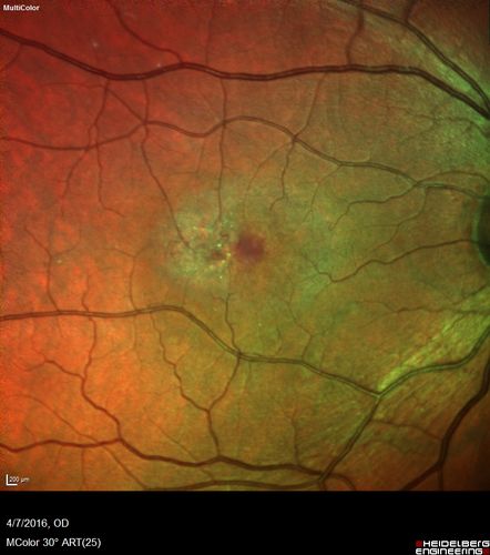 Macular Telangiectasis - visible telangiectasia on color photos
Multicolor photos too show pathology.  This patient had 20/50 vision with pinhole to 20/25
