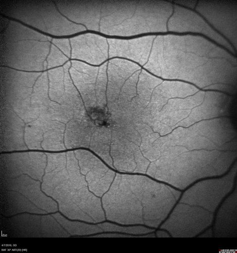 Macular Telangiectasis - visible telangiectasia on color photos
Multicolor photos too show pathology.  This patient had 20/50 vision with pinhole to 20/25
